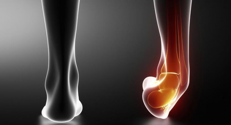 Esguince o torcedura de tobillo, impacta en biomecánica del aparato locomotor y del cuerpo en general