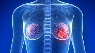 Nuevo tratamiento para el cáncer triple negativo, ayuda a que las pacientes logren recuperarse
