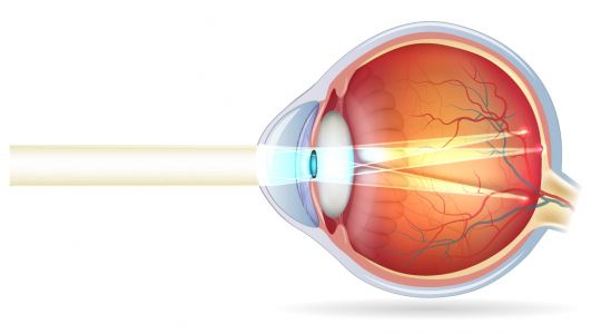 Astigmatismo puede desencadenar en trasplante corneal