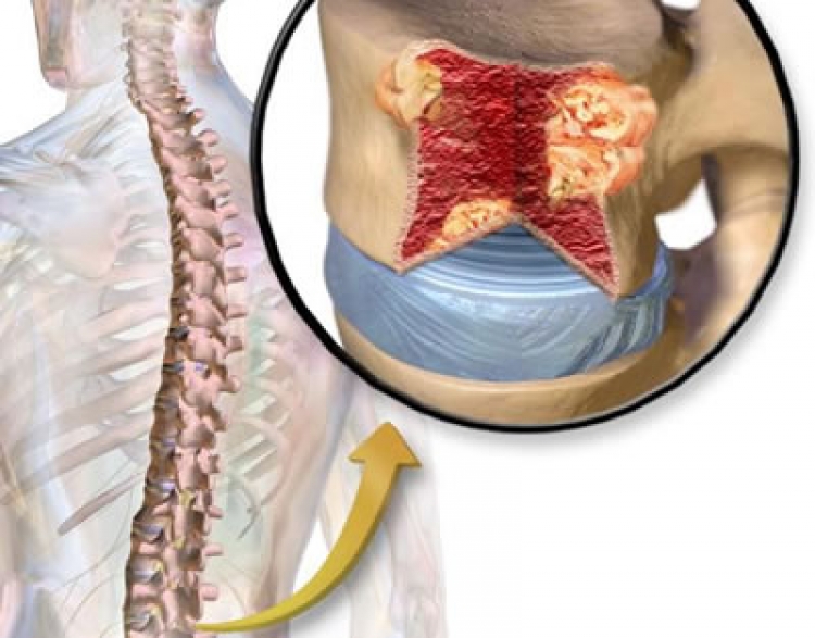 ¿Te fracturas sin razón aparente? Cuidado podría tratarse de mieloma múltiple