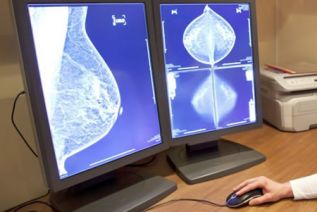 Investigadores de Mayo Clinic identifican posible método nuevo para tratar cáncer de mama HER2 positivo   