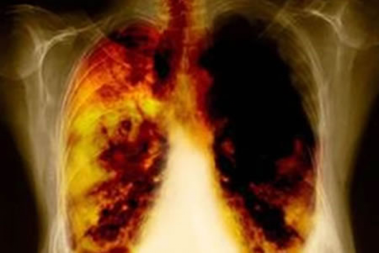 AMGEN anuncia alentadores resultados con nueva terapia para cáncer de pulmón