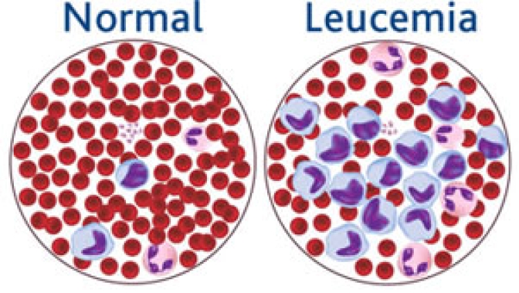 Moretones y sangrado sin causa aparente: síntomas comunes que podrían indicar algún tipo de leucemia