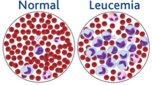 Moretones y sangrado sin causa aparente: síntomas comunes que podrían indicar algún tipo de leucemia