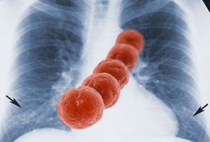 Neumonía: una infección respiratoria grave que requiere atención