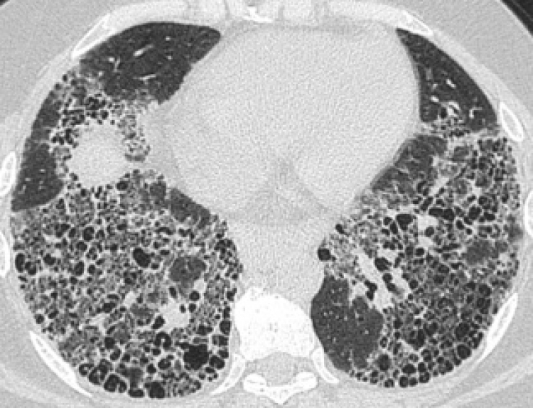 Innovadora terapia ofrece a pacientes con Fibrosis Pulmonar Idiopática mejor calidad de vida