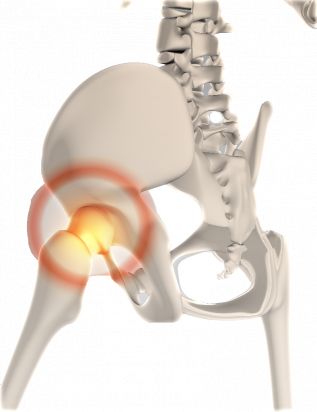 Evitan microesferas antibióticas infecciones en reemplazos de articulaciones