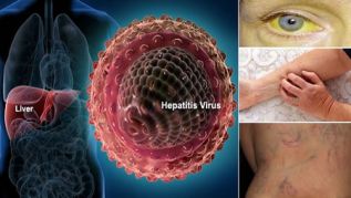 En el mundo alrededor de 140 millones de personas padecen infección crónica por el virus de la hepatitis C 