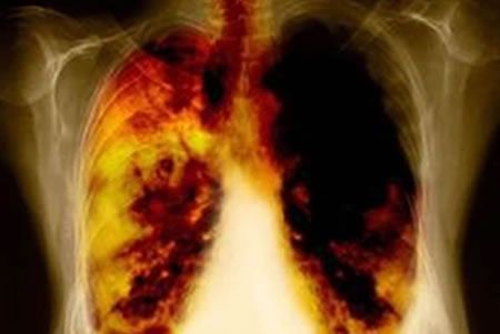 Tabaquismo, principal causa de cáncer de pulmón