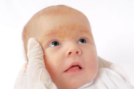 Medicina dermatológica multidisciplinaria, ayuda en el tratamiento de la dermatitis atópica 