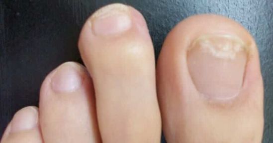 Consejos de Mayo Clinic: Tratamiento de los hongos en las uñas de los pies