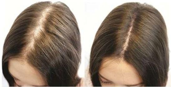 El 40% de las mujeres mayores de 20 años, sufren de efluvio telógeno, por lo menos una vez en su vida