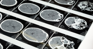 Médicos de Mayo Clinic proponen un nuevo modelo computacional para controlar, prevenir y tratar el Alzheimer