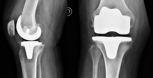 Reemplazo articular de rodilla, opción para recuperar movilidad