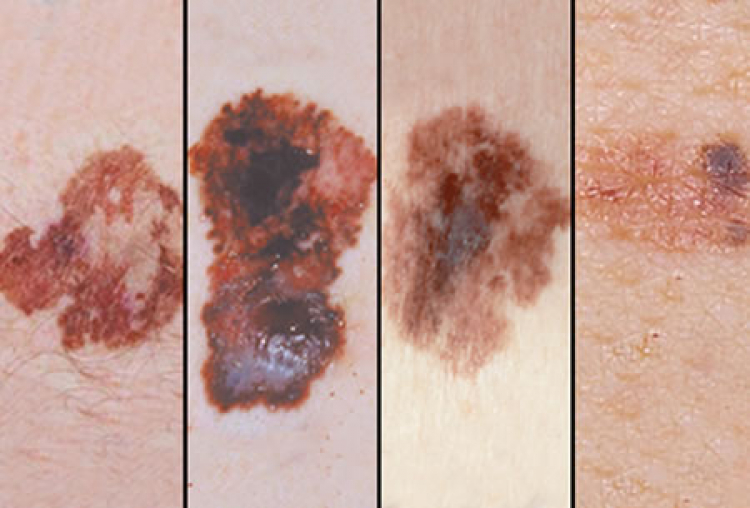 Presentan guías de tratamiento de melanoma