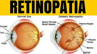 Tabaquismo aumenta riesgo de degeneración macular y retinopatía diabética