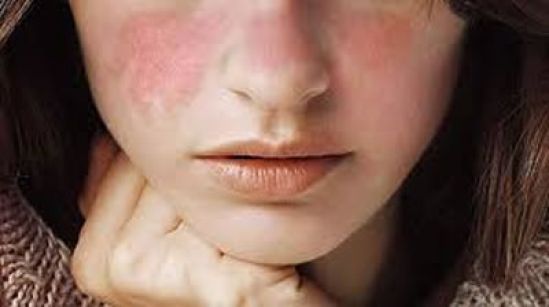 En México, nueve de cada diez mujeres en etapa productiva que padecen lupus