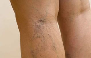Soluciones de Terapia integral, aliadas en el combate de trastornos venosos