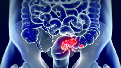 El cáncer de colon y recto es el tercer tipo de cáncer más frecuente en México