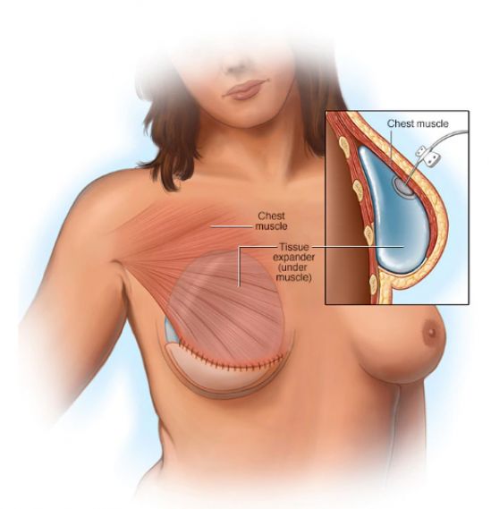 Cáncer de mama: reconstrucción con implantes