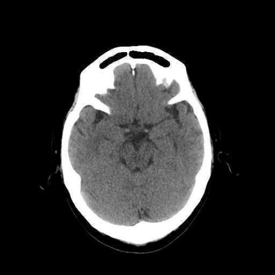 México se prepara para una mejor atención del infarto cerebral