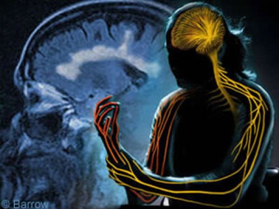 Esclerosis Múltiple, padecimiento que se puede presentar desde los 20 años 