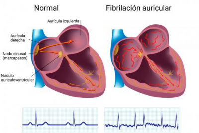 Especialistas alertan sobre fibrilación auricular, una arritmia grave y silenciosa