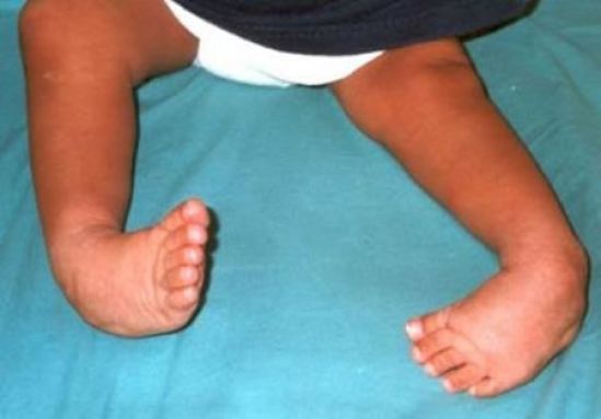 Inicia campaña de donación "Primeros pasos" para ayudar a caminar a niños con Pie Equino Varo Aducto