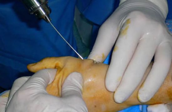 El dolor causado por la rizartrosis, se acentúa en la temporada de frío