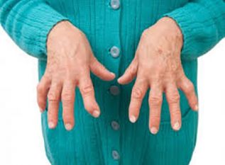 Pacientes con artritis reumatoide se ven afectados por discapacidades mucho antes del diagnóstico