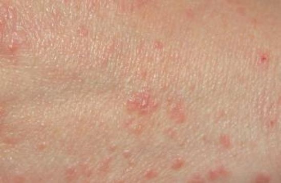 La sarna, ha afectado al 90% de la población de pequeños asentamientos