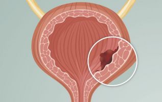 OPINIÓN :: Nueve de cada diez personas con cáncer de vejiga, tienen más de 55 años