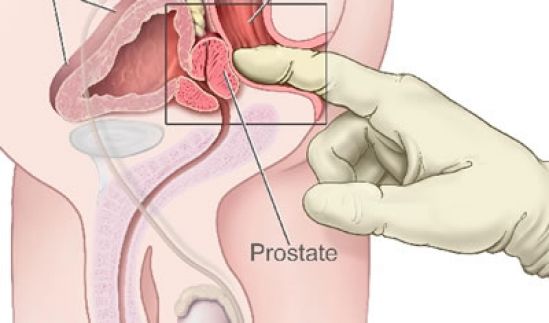 Nuevo tratamiento para hiperplasia prostática benigna emplea vapor para reducir el tamaño de la próstata y aliviar los síntomas