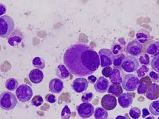 Ibrutinib muestran una eficacia durante cinco años de tratamiento para la leucemia linfocítica crónica/linfoma linfocítico de células pequeñas 