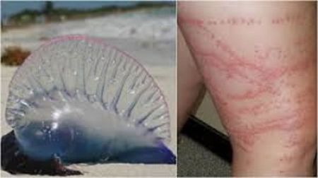 Cuidado con la Aguamala, son un peligro en la playa