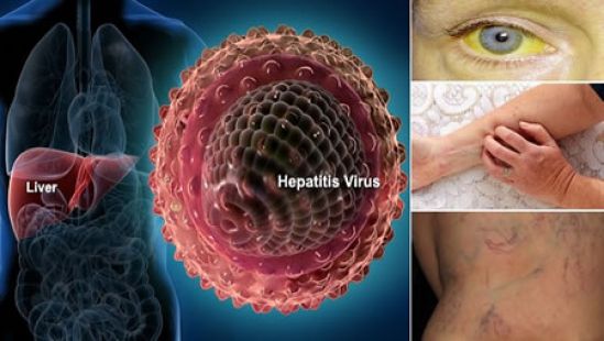 Alerta de Hepatitis como problema de salud pública en México