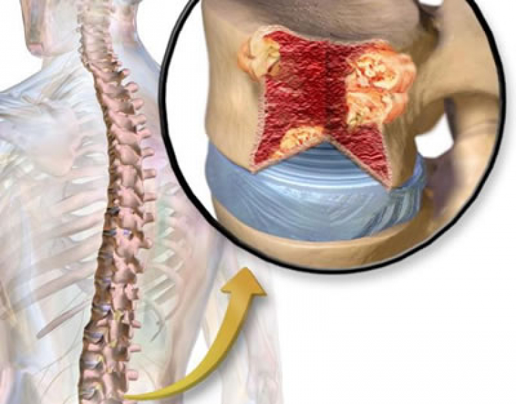 FDA aprueba nuevo régimen combinado de carfilzomib con daratumumab y dexametasona en dosificación de una y dos veces por semana en pacientes con mieloma múltiple