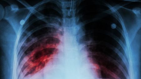 Abren registro latinoamericano de pacientes con fibrosis pulmonar idiopática para detección oportuna