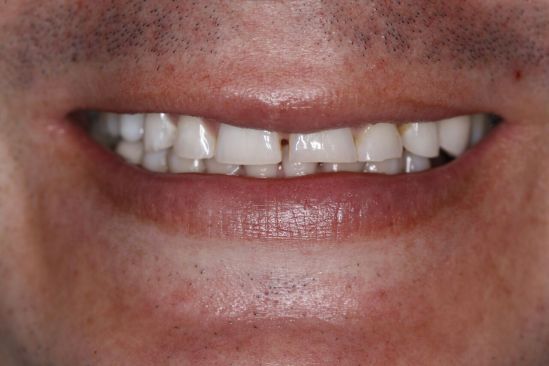 Cómo aliviar las molestias por rechinar los dientes
