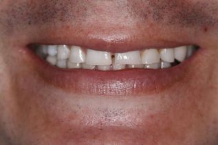 Cómo aliviar las molestias por rechinar los dientes