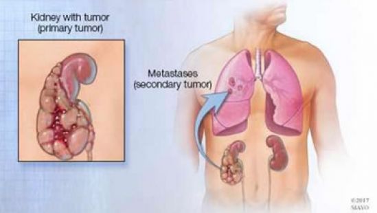 Se reúnen especialistas internacionales en cáncer de riñón para impulsar la generación de políticas públicas en México