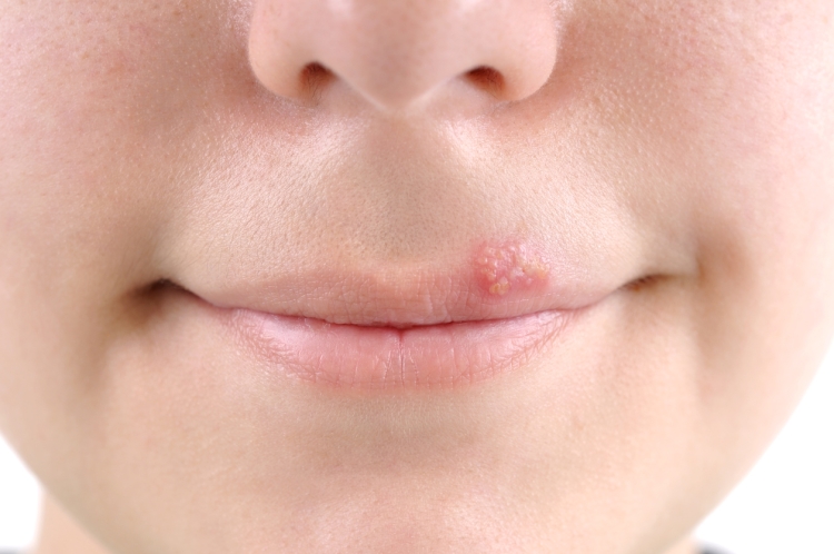 Uno de cada tres adultos mayores de 50 años en México podría desarrollar herpes zóster en su vida