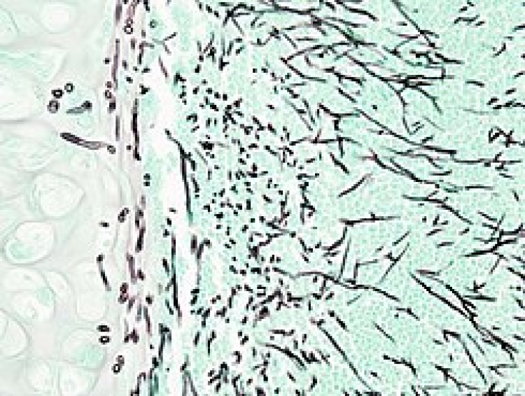 Aspergilosis, segunda causa de muerte de las enfermedades micóticas
