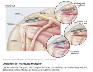 ¿Qué tan comunes son los desgarres del manguito rotador?