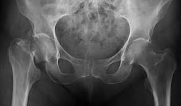AMMOM lanza micrositios y dossier informativo sobre el panorama actual de la osteoporosis en México