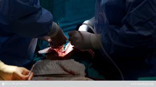 Repetir baipás de la arteria coronaria con injerto mejora la supervivencia a largo plazo: Mayo Clinic