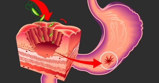 Investigadores del Cinvestav detectan un nuevo mecanismo asociado a la formación de las úlceras intestinales