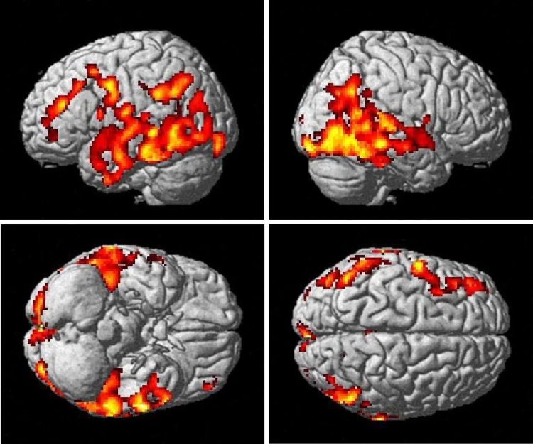 Investigadores de Mayo Clinic identifican cambios vasculares en el cerebro relacionados con la enfermedad de Alzheimer   