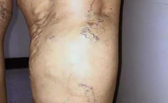 En México entre el 70 y 80 % de la población mayor de 60 años padece várices 