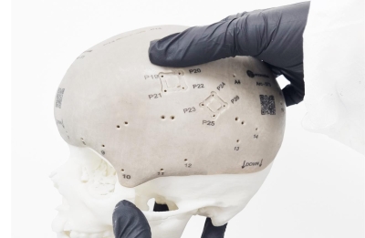 Utilizando tecnología de impresión 3D: Startup fabrica el implante craneal más grande del mundo
